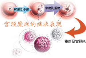 得了宫颈糜烂会有什么症状呢
