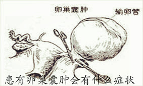 患有卵巢囊肿会有什么症状
