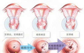得了宫颈糜烂会有什么症状呢