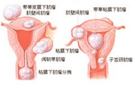 卵巢囊肿的治疗方法有哪些